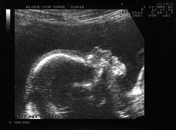 Фото УЗИ на 12 неделе беременности