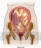 ► Особенности родов при анатомически узком тазе