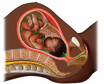 ► TORCH-инфекции при беременности