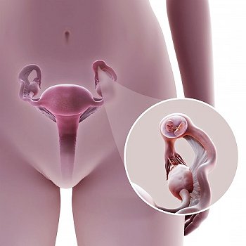 ► Внематочная беременность: причины, симптомы, последствия