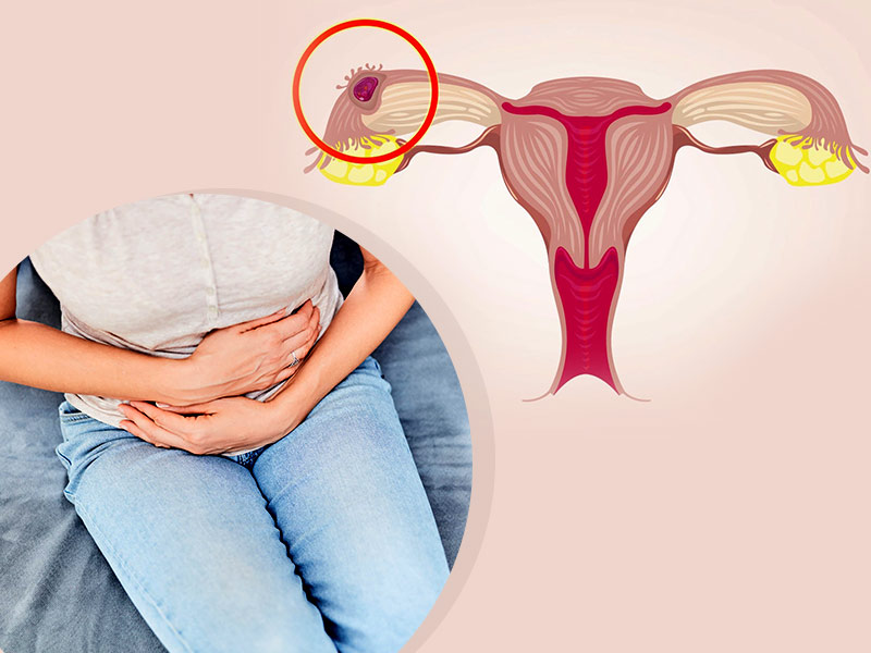 Хотите узнать, почему возникает внематочная беременность? Представляем причины, почему беременность бывает внематочной!