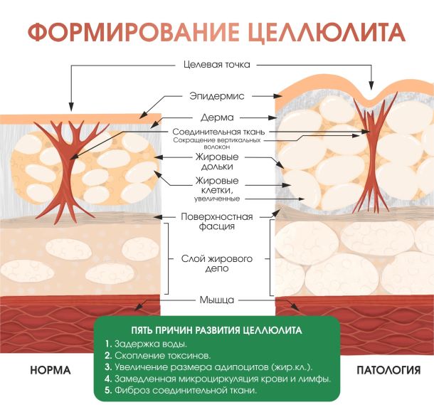 Причины возникновения целлюлита